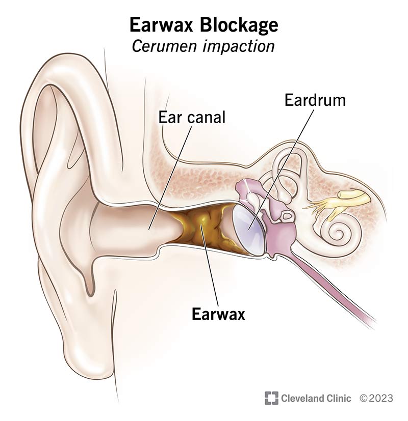 earwax